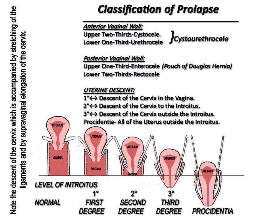 grading-a-prolapse-your-pessary