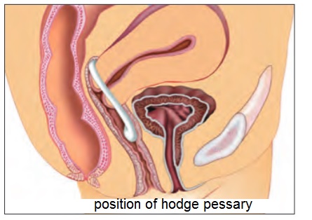 Use of Vaginal Pessary in Geriatric Women